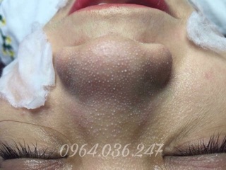 Tinh chất ủ trồi mụn