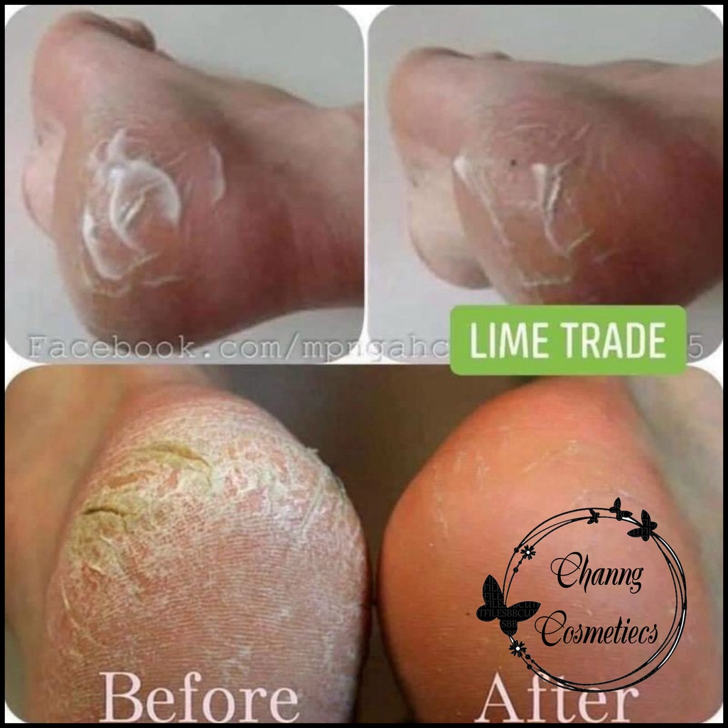 Kem giảm nứt gót chân YouGreen Hàn Quốc 60gr