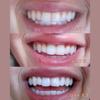 Miếng dán răng Crest 3D 1 HỘP 4 PACK ( CÓ SẴN)