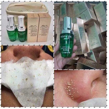 Ủ Mụn | Ủ mụn Đầu Đen - Mụn Cám Chuyên Dụng cho spa thẩm mỹ viện