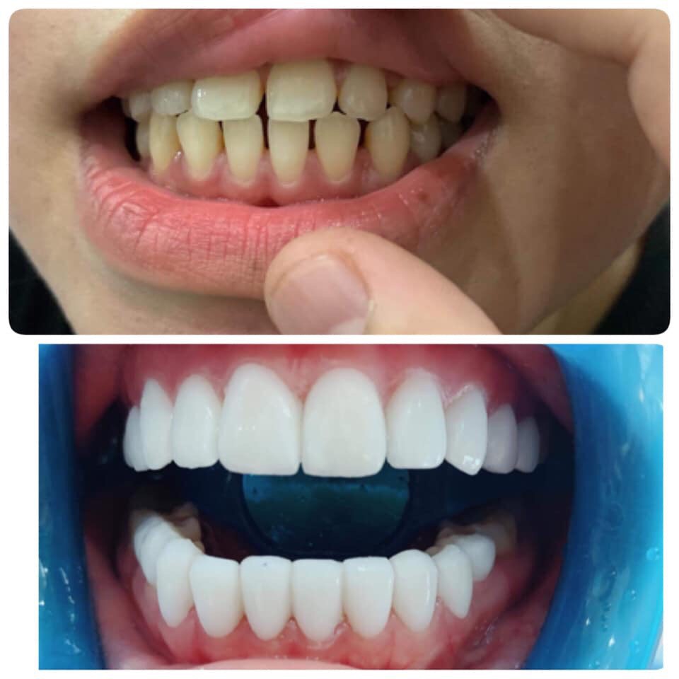 Bộ tạo hình nha khoa_phủ răng sứ biovenees