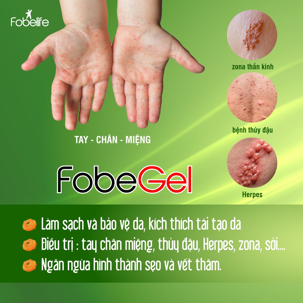 Gel tái tạo da do thủy đậu giời leo Fobe Gel tuýp 30g