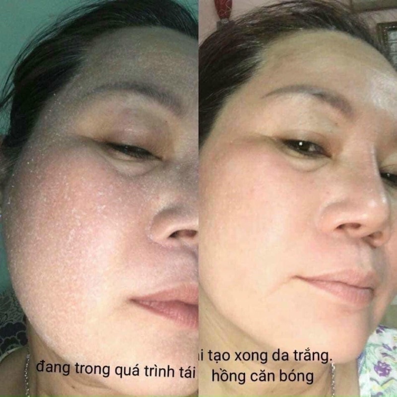 Kem Tái Tạo Da Đông Y Cao Cấp Kim Spa Mụn Nám Tàn Nhang