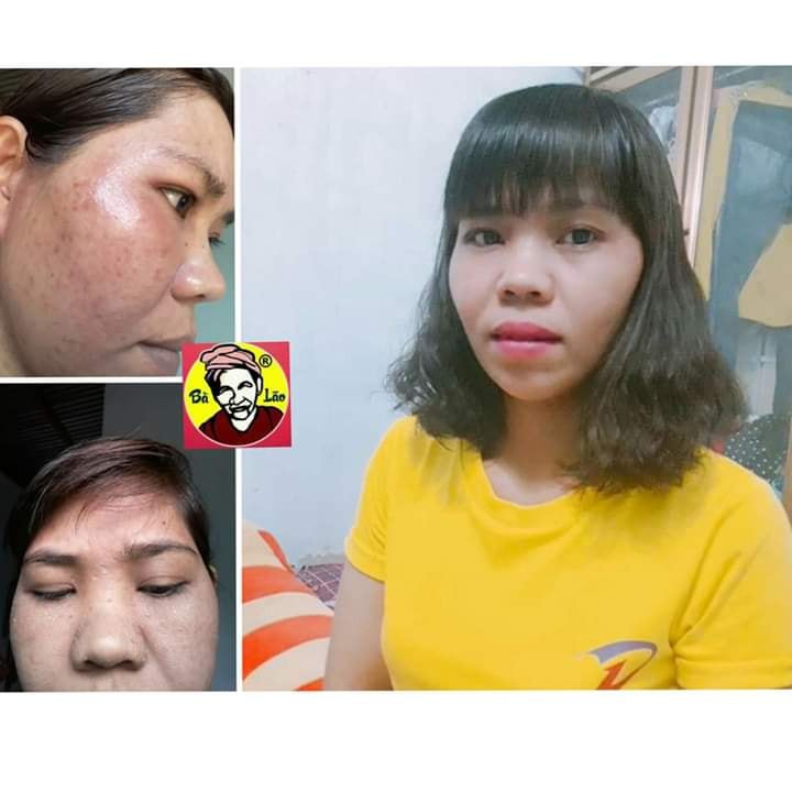 Combo Tri Mụn Cao Cấp Bà Lão