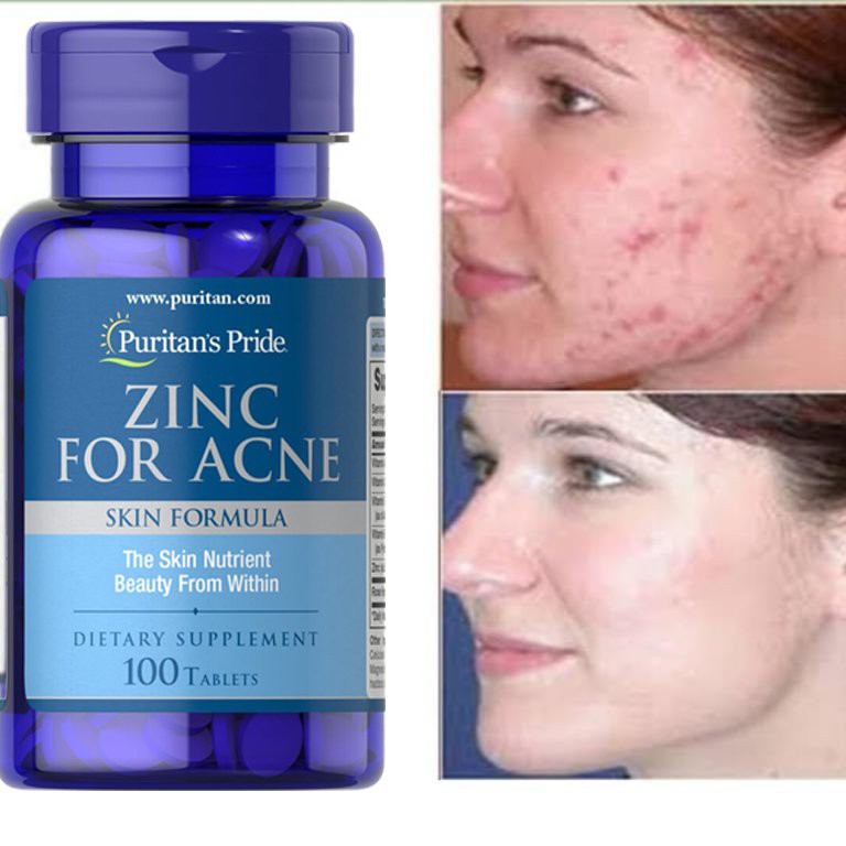 Viên Bổ Sung Kẽm Giảm Mụn ZINC FOR ACNE 100 Viên