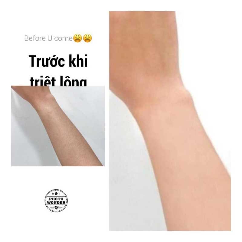 Máy triệt lông Naotime Beauty B65Pro, Máy triệt lông lạnh mini vĩnh viễn vô hạn xung, đầu triệt lạnh đá saphire mới nhất