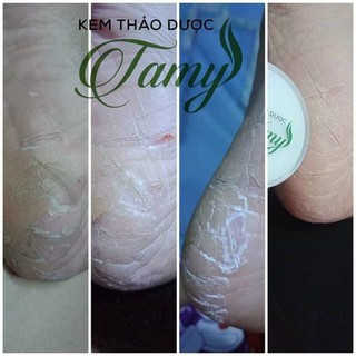 COMBO 2 HỘP KEM TAMY THẢO DƯỢC