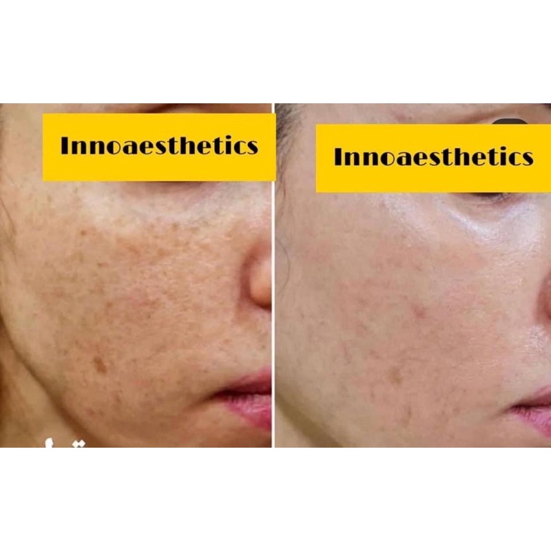 Meline 02 caucasian night, caucasian day - huyết thanh giảm thâm sạm nám 20gr