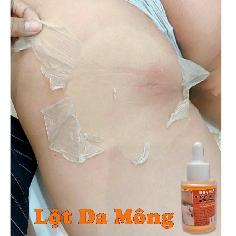 Lột Thay Da Tái Tạo Bụng Mông Bẹn Mờ Rạn Nứt Hết Thâm Sạm