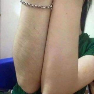 Tẩy lông Kone