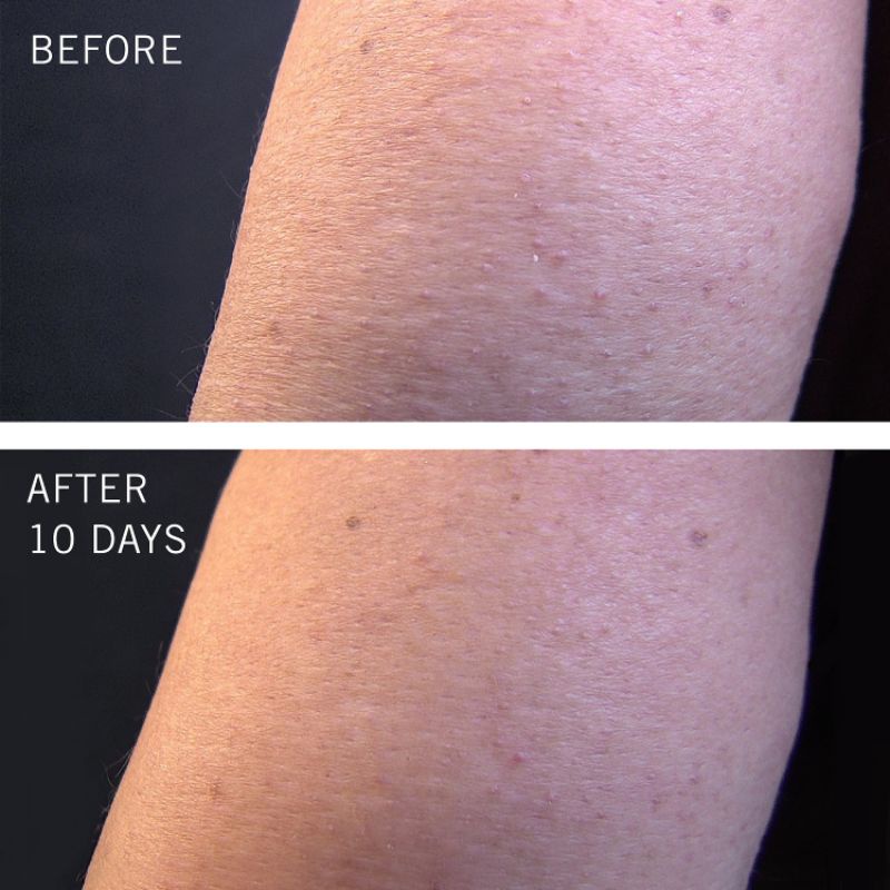 Tẩy da chết & Dưỡng thể body First Aid Beauty KP Bump Eraser Body Scrub 226g