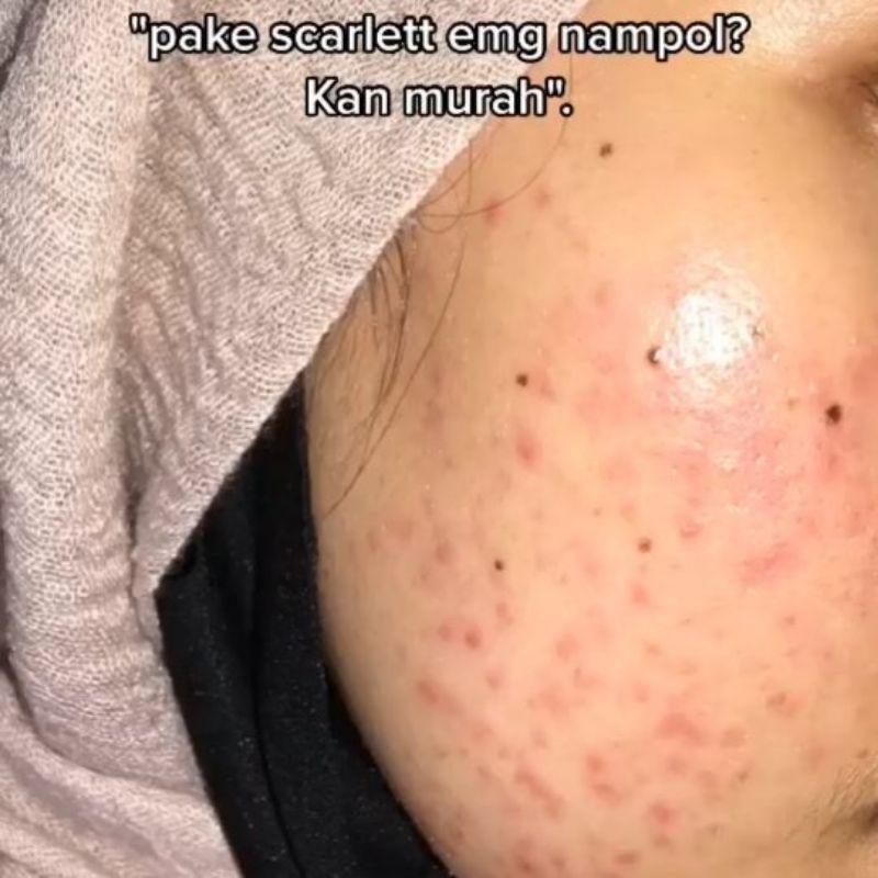 (Hàng Mới Về) Serum Trị Sẹo Mụn Làm Sáng Da Hiệu Quả