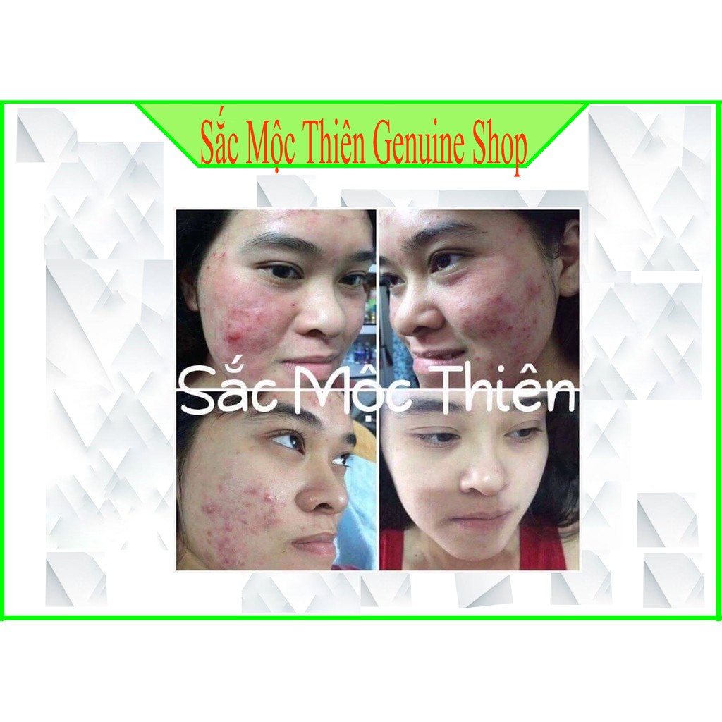Tái Tạo Sắc Mộc Thiên -Làm bay  mụn , nám , tàn nhang- Cam kết hoàn tiền 100% nếu không hiệu quả . | BigBuy360 - bigbuy360.vn