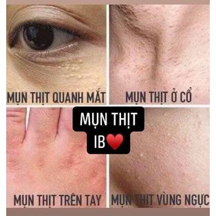 HÀNG CHÍNH HÃNG - Kem mụn thịt và quầng thâm mắt Gentian Eye   ngocsu19999