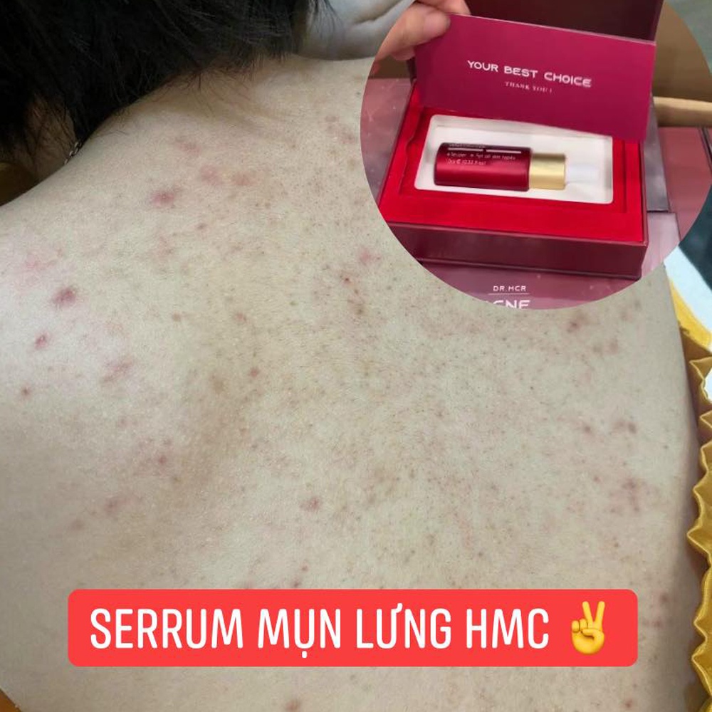 Serum giảm mụn lưng, mụn ,mặt,  nang lông 10ML N'Cell Anti Acne - Tinh chất mờ thâm nám Bright serum N'cell