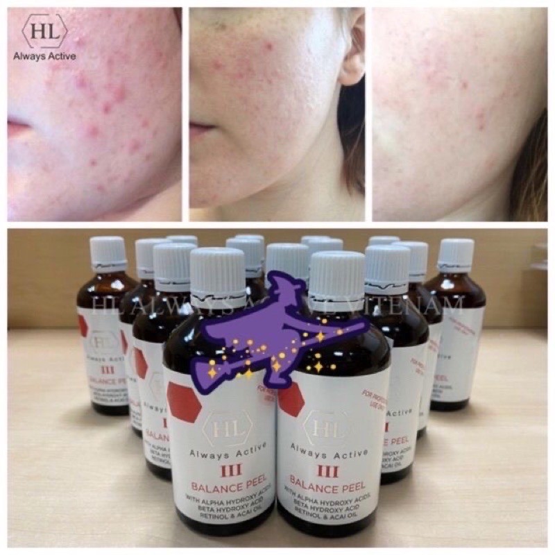 Balance Peel III Chuyên Dành Cho Da Mụn Thanh Lọc Lỗ Chân Lông và Thâm Mụn