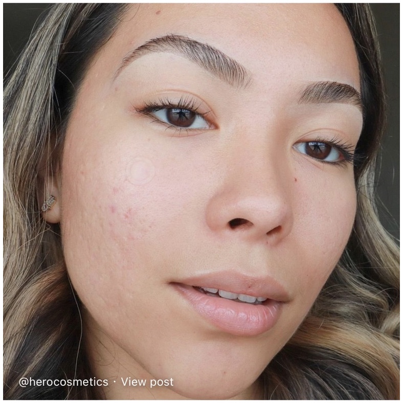 Dán mụn Hero Mighty Patch