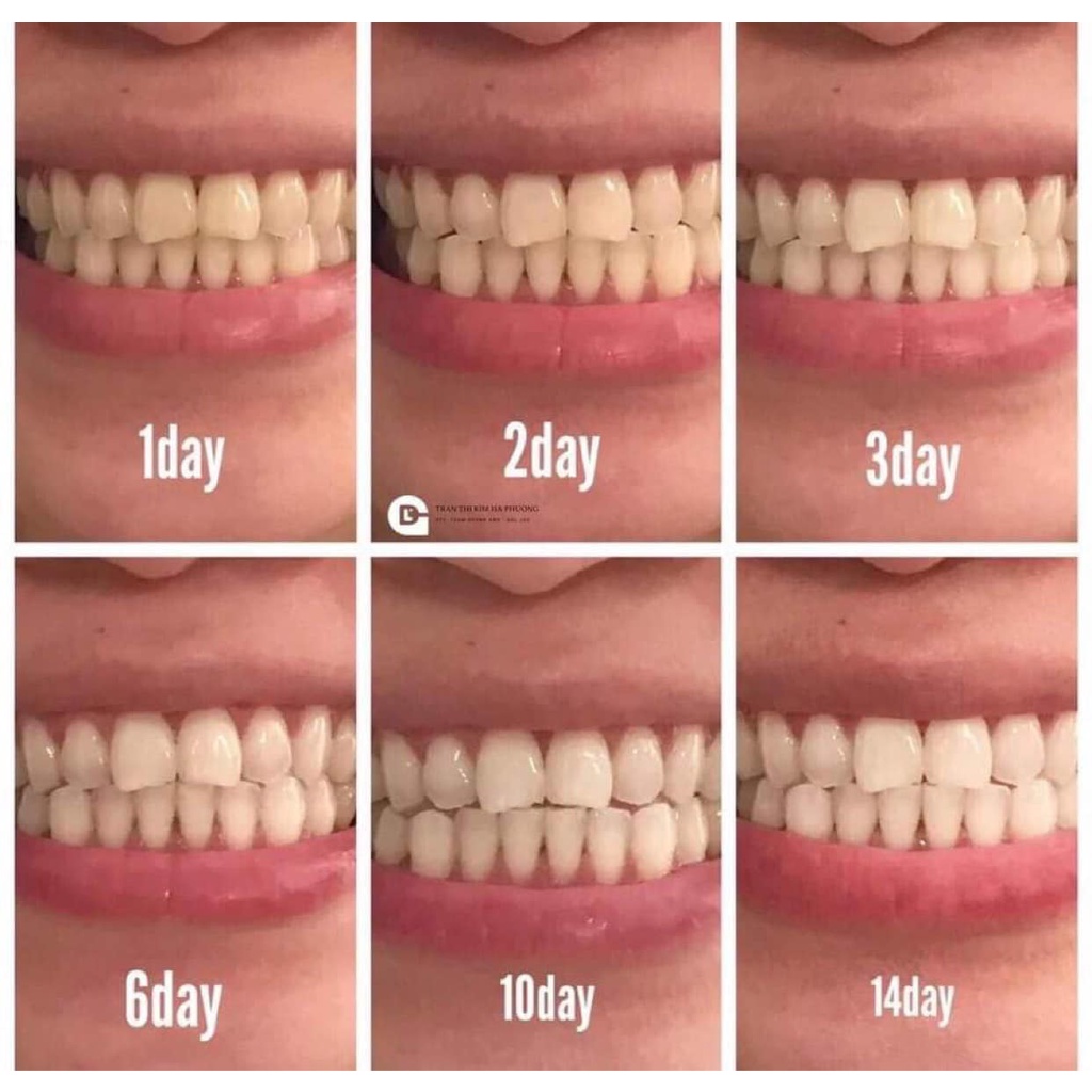 KEM ĐÁNH RĂNG COLGATE OPTIC WHITE RENEWAL CỦA MỸ 116G (REMOVES 10 YEARS OF YELLOW STAINS)