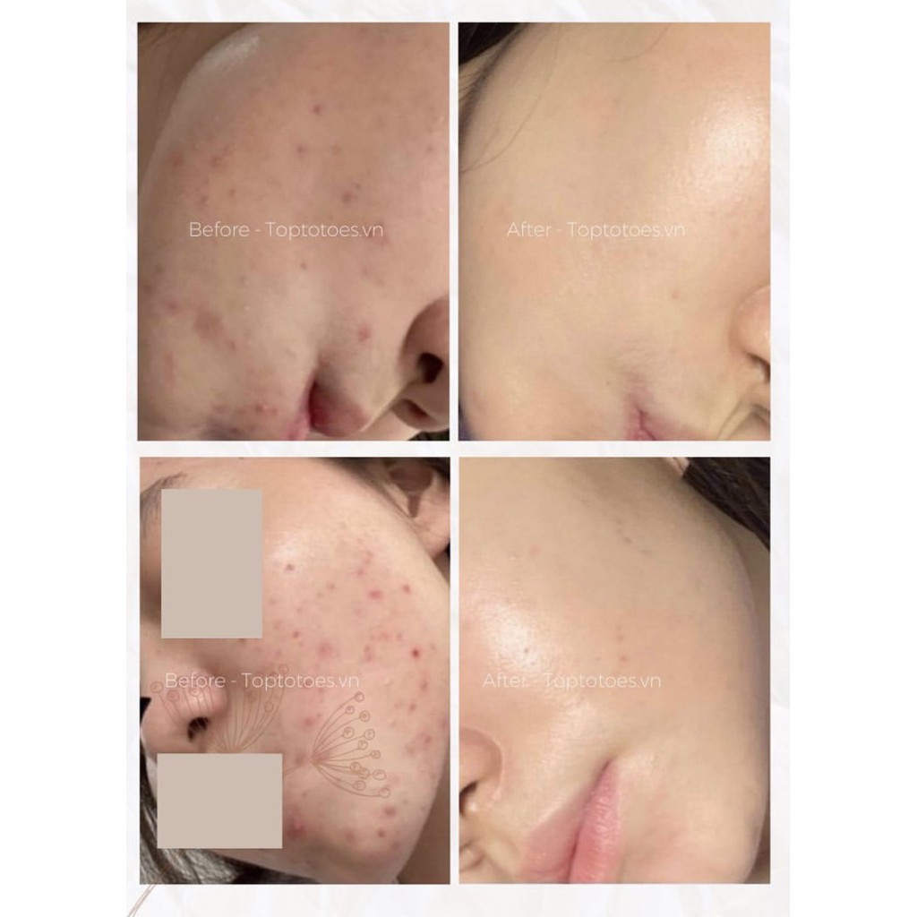 Serum Teana Anti-redness &amp; No Problem cho da mụn