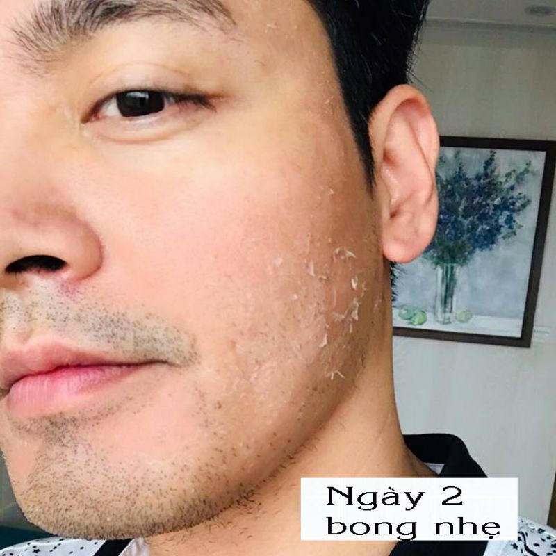 Peel Da Lột Nám Sạm Tàn Nhang Đồi Mồi