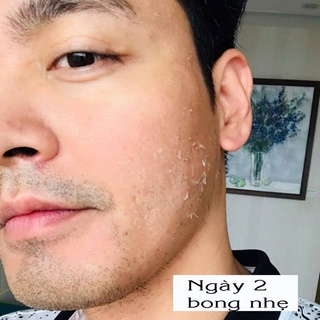 Peel Da Lột Nám Sạm Tàn Nhang Đồi Mồi