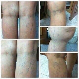 KEM TRỊ SUY GIÃN TĨNH MẠCH