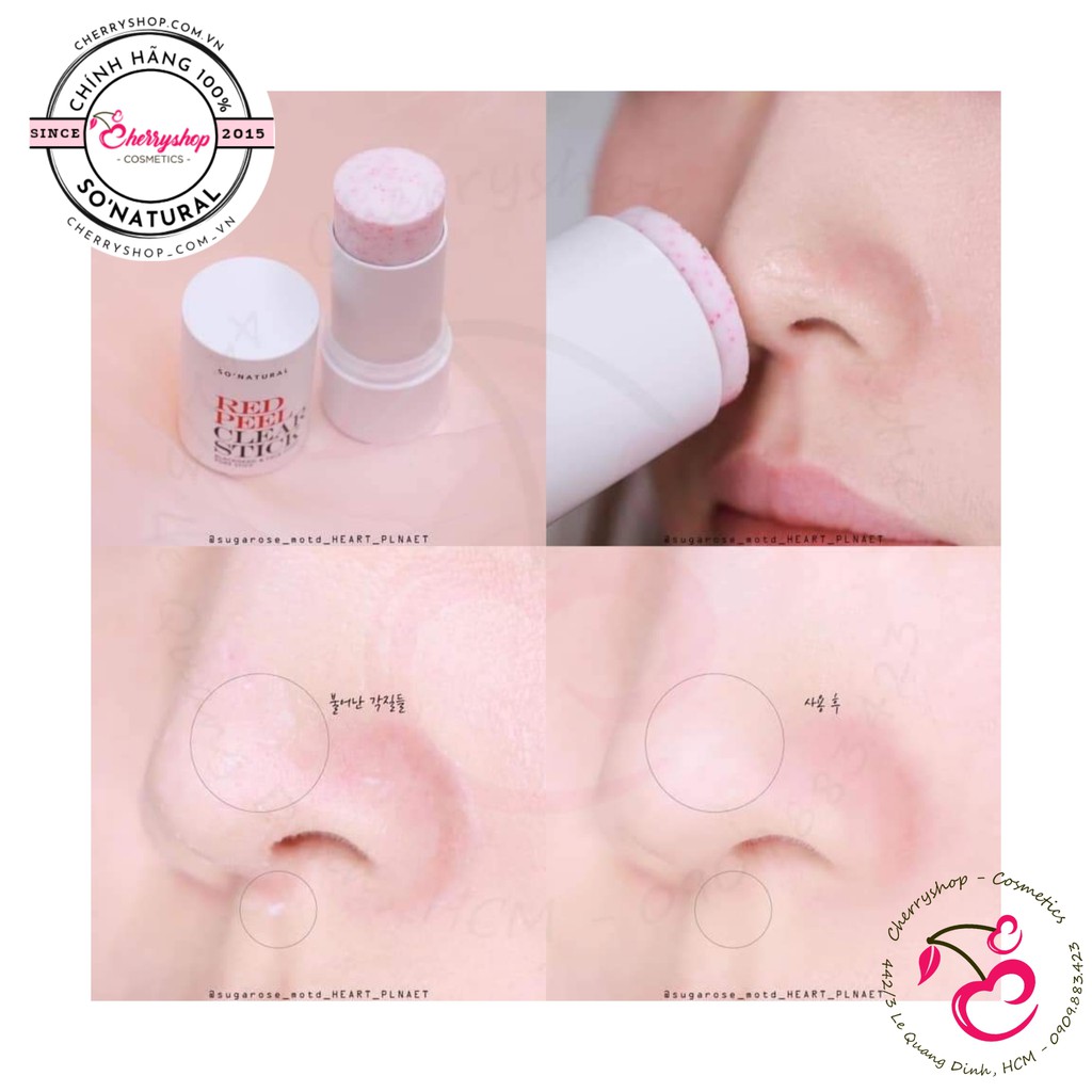 Thanh lăn mụn So’natural Red Peel Clear Stick