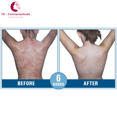 Kem Bôi Da Bioskin Zeoderm Ngừa Eczema, Vẩy Nến, Mề Đay, Viem Da - 50ml