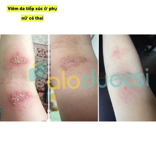 Xịt kháng khuẩn Maxibac ( bộ đôi xịt + gel maxibac)