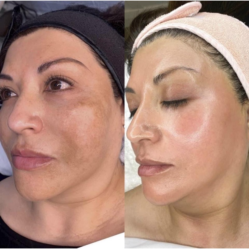 Kem Dưỡng Mờ Nám Tàn Nhang Mesoestetic Cosmelan 2