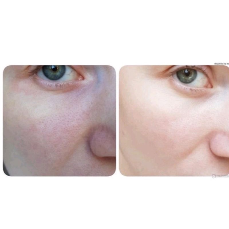 Liệu trình thay da teane trong 10 ngày