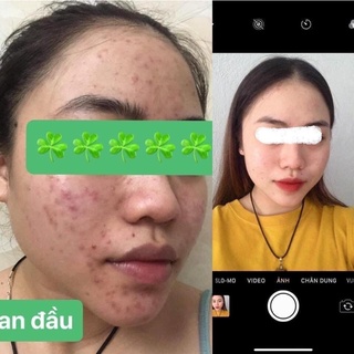 TUÝT THOA ACNE DERM