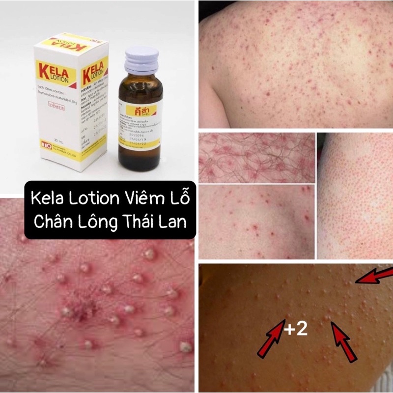 [CHỈ BÁN HÀNG THÁI] LOTION KELLA VIEM LỖ CHÂN LÔNG THÁI LAN [SẴN]