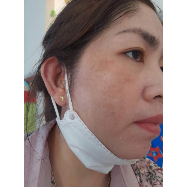 Kem Face nám tàn nhang da không đều màu