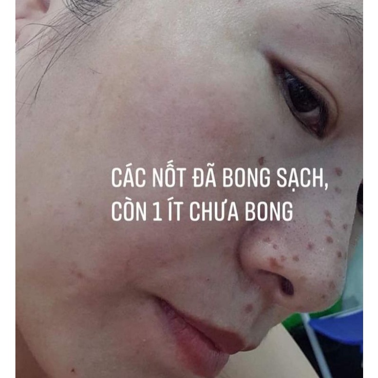 Combo 2 sp chấm nám tàn nhang.