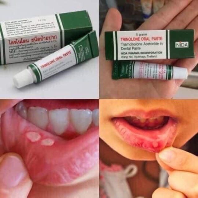 kem bôi nhiệt miệng