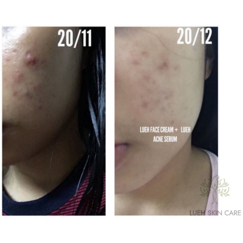 Acne Serum LUEH - The Green Tea Seed Serum