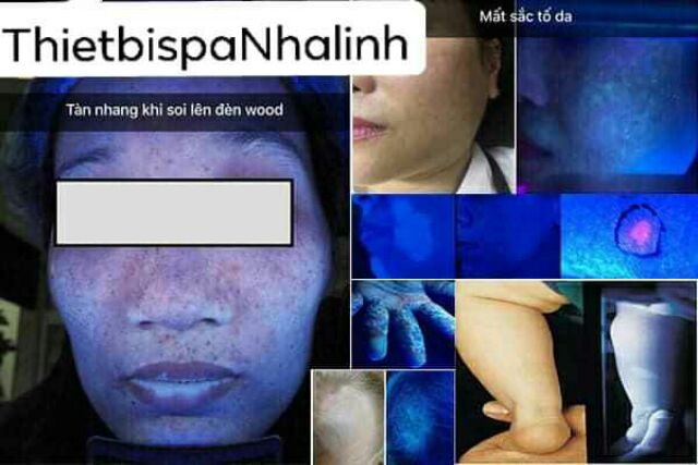 ĐÈN WOODD SOI,  PHÂN TÍCH DA DÀNH CHO SPA,  THẨM MỸ VIỆN