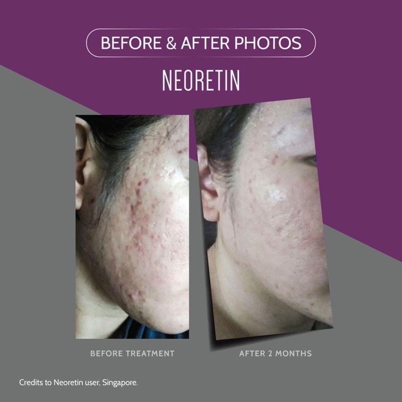 Serum trắng da, mờ thâm nám tàn nhang Neoretin Discrom Control Serum Booster Fluid 15ml