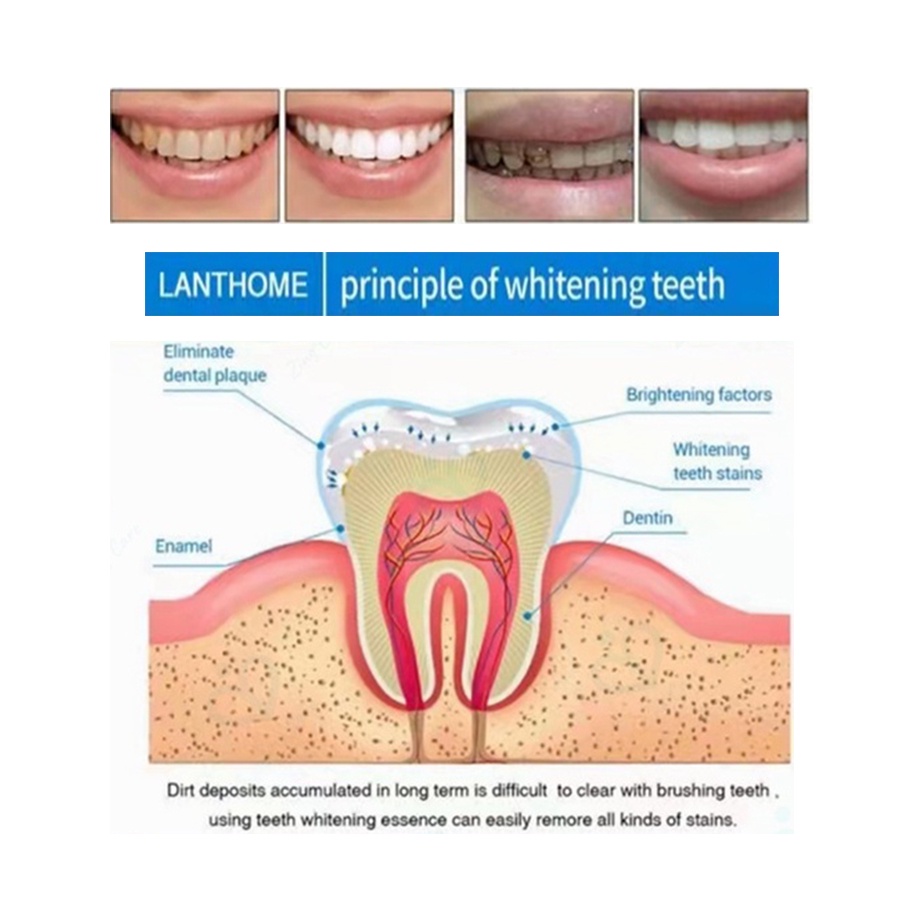 Loại bỏ các vết bẩn răng trắng bút trắng sáng chói răng trắng răng quay peroxide gel