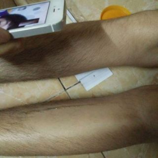 Combo triệt lông vĩnh viễn