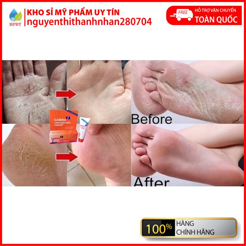 Kem Gamma Cracked Heel sản phẩm chuyên dùng cho da khô nứt nẻ cho kết quả cực kỳ tốt, dùng cho nứt gót chân, khô nút da
