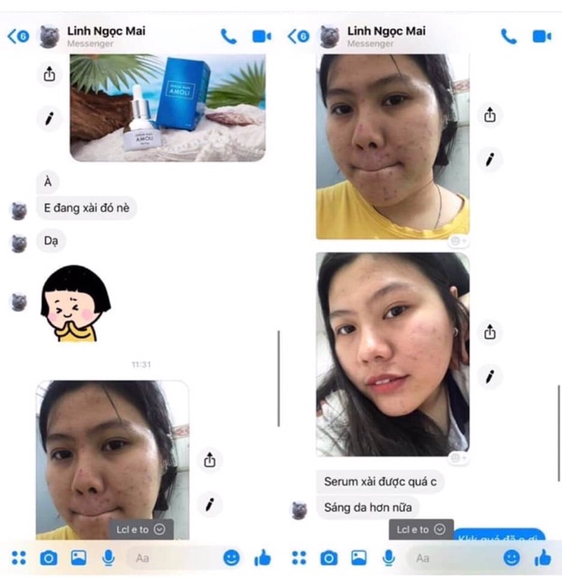 Serum Trị Mụn Amoli | BigBuy360 - bigbuy360.vn