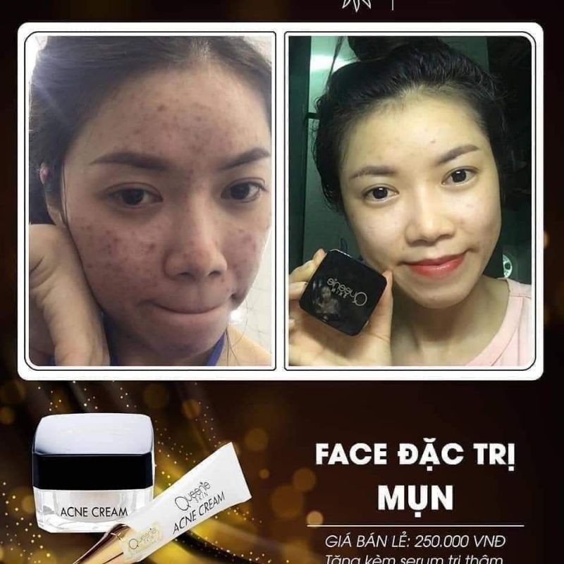 KEM FACE MỤN, LÀM SÁNG DA QUEENIE SKIN