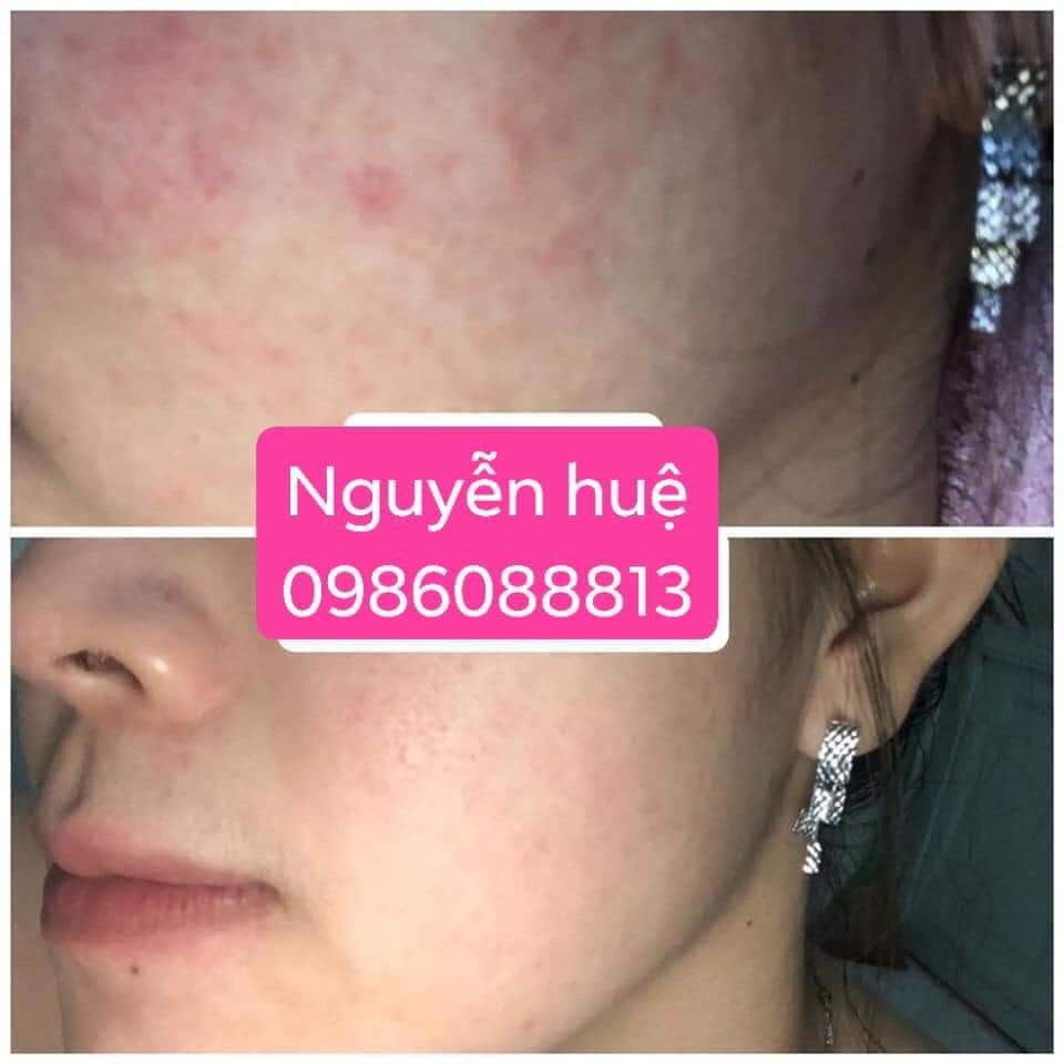 Kem Couperose Skin Therapy thanh lọc da nhiễm corticoit, phục hồi da yếu mỏng đỏ kích ứng