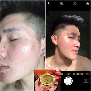 Cao Mụn Sâm Đỏ 36 Vị