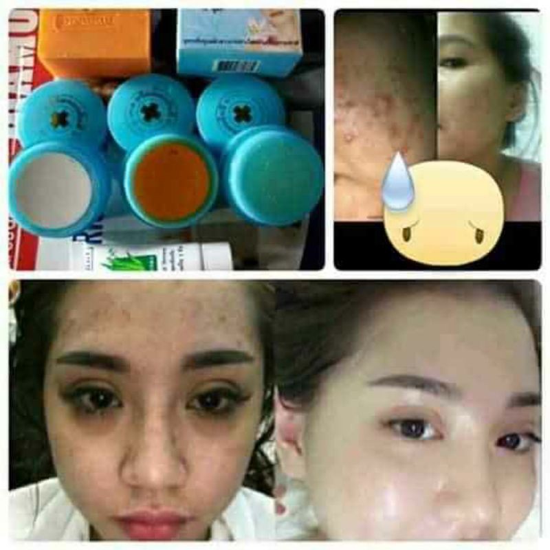 KEM GIẢM MỤN,NÁM, TÀN NHANG, DA ĐEN SẠM (THÁI) | BigBuy360 - bigbuy360.vn