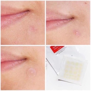 MIẾNG DÁN HÚT MỤN COSRX ACNE PIMPLE MASTER PATCH