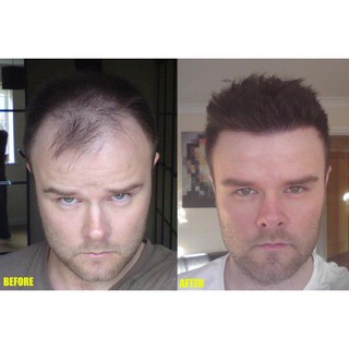 Minoxidil - Dung dịch hỗ trợ mọc tóc cho nam