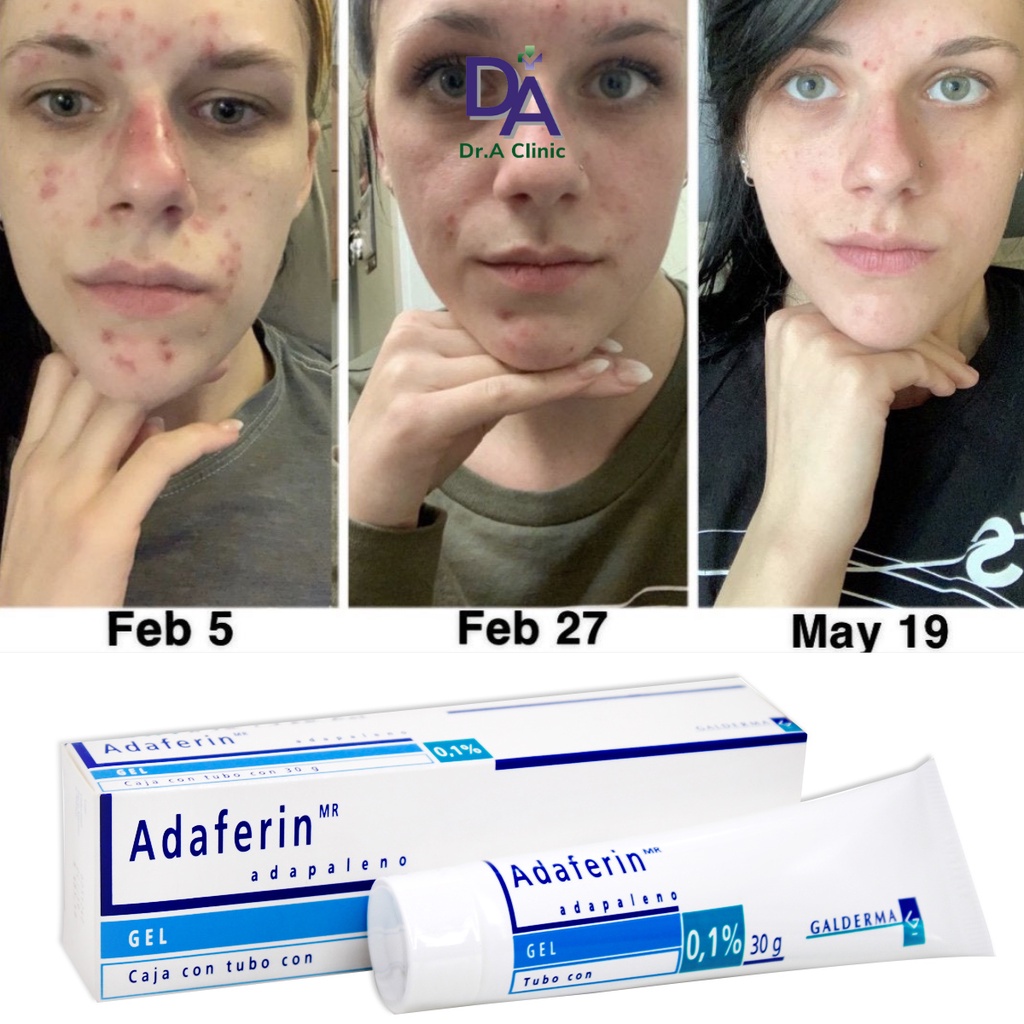 Adapalene Gel 0.1 Adaferin Chính Hãng Dr.A Clinic giúp giảm mụn ẩn mụn trứng cá mụn đầu đen hiệu quả